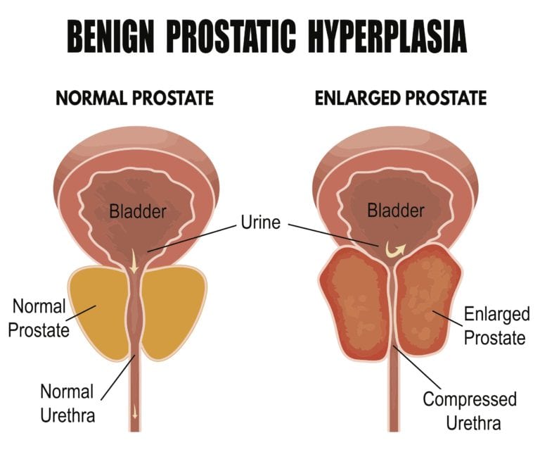 Laser Ablation Enlarged Prostate Treatment Chattanooga TN UT