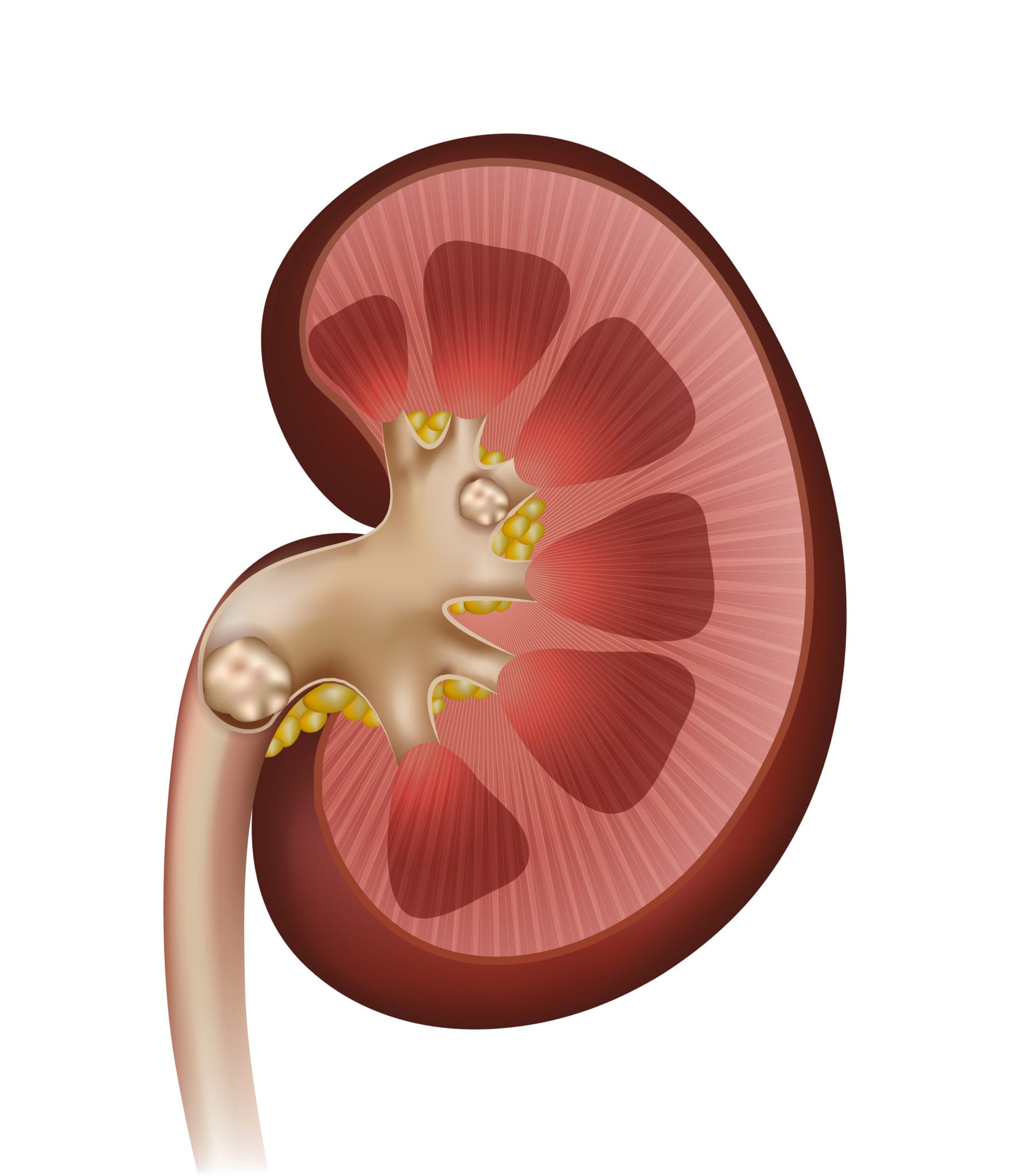 Kidney Stones Chattanooga TN Kidney Stone Treatment